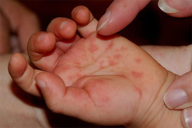 Вирусна инфекција код деце - у Зајечару проглашена епидемија (видео)