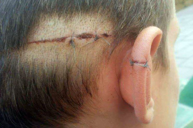 УЖАС У У СУБОТИЦИ: Мигрант исекао из чиста мира дечака скалпелом по глави